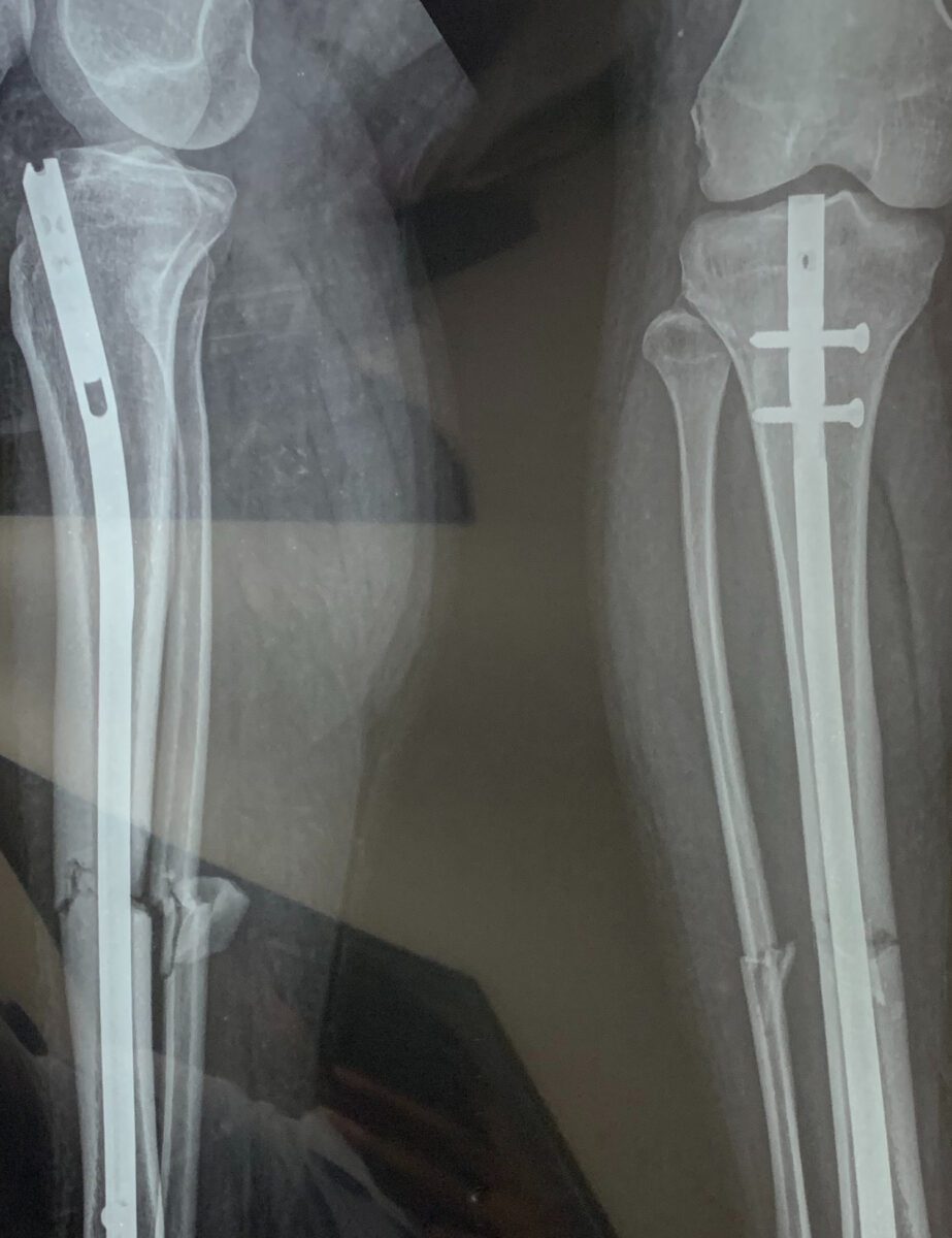 X-ray